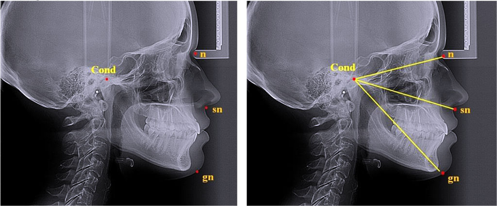 Fig. 2. Major reference points for analyzing nasal and gnathic face parts on teleroentgenograms, lateral projection