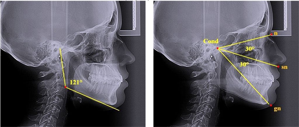 Fig. 3. Angular parameters, nasal and gnathic part of face; teleroentgenograms, lateral projection; neutral type of growth