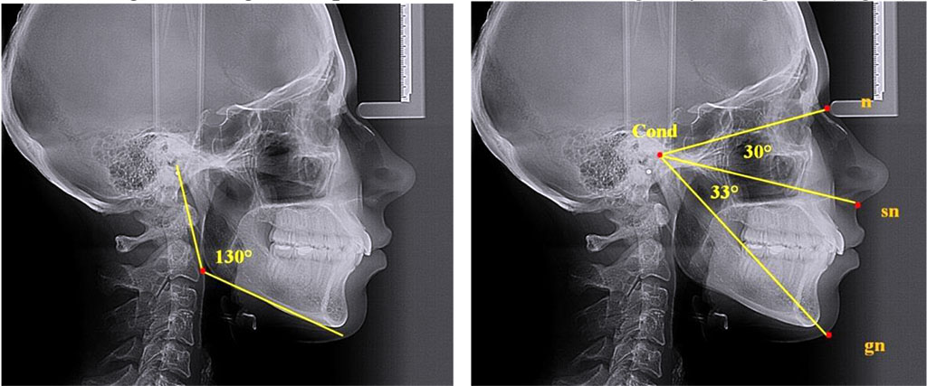 Fig. 4. Angular parameters, nasal and gnathic parts of face; teleroentgenograms in lateral projection, vertical growth type