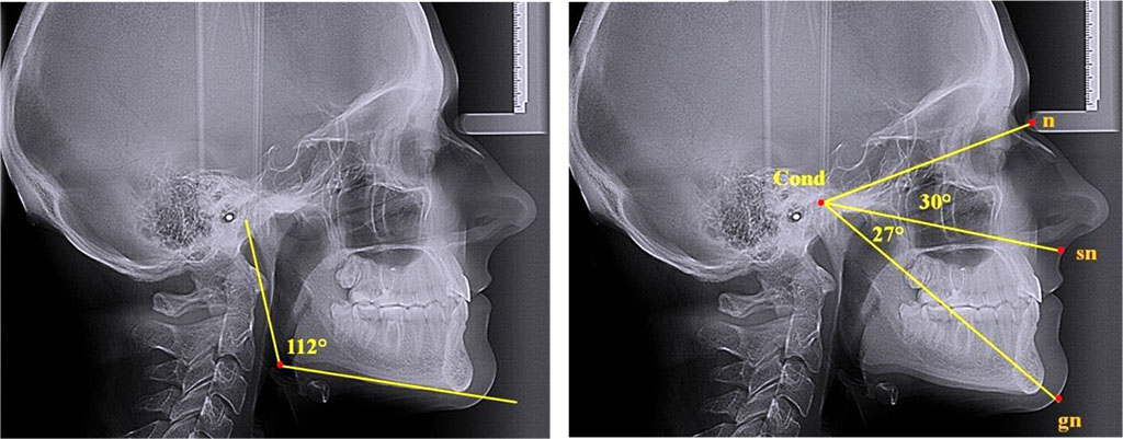 Fig. 5. Angular parameters of nasal and gnathic part of face; teleroentgenograms, lateral projection; horizontal growth type