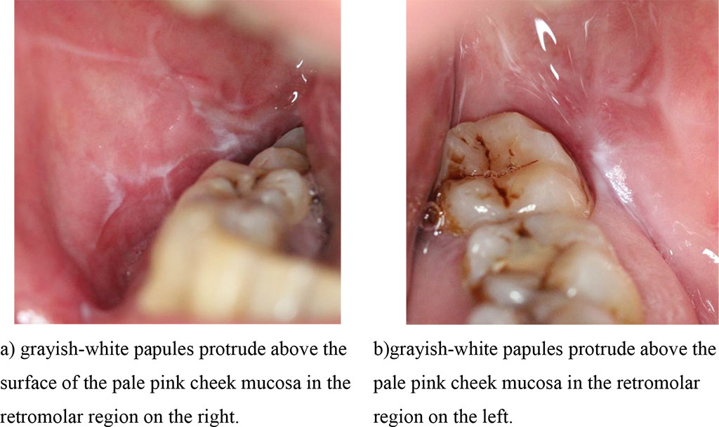 Fig.1 (a, b). Clinical manifestations of a typical form of lichen planus before treatment.