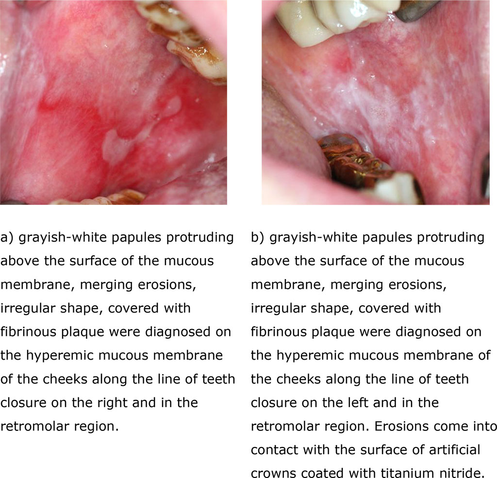 Fig. 3 (a, b). Clinical manifestations of erosive-ulcerative form of lichen planus before treatment