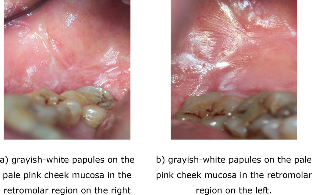 Fig. 4 (a, b). Clinical manifestations of a typical form of lichen planus after treatment (after 14 days)