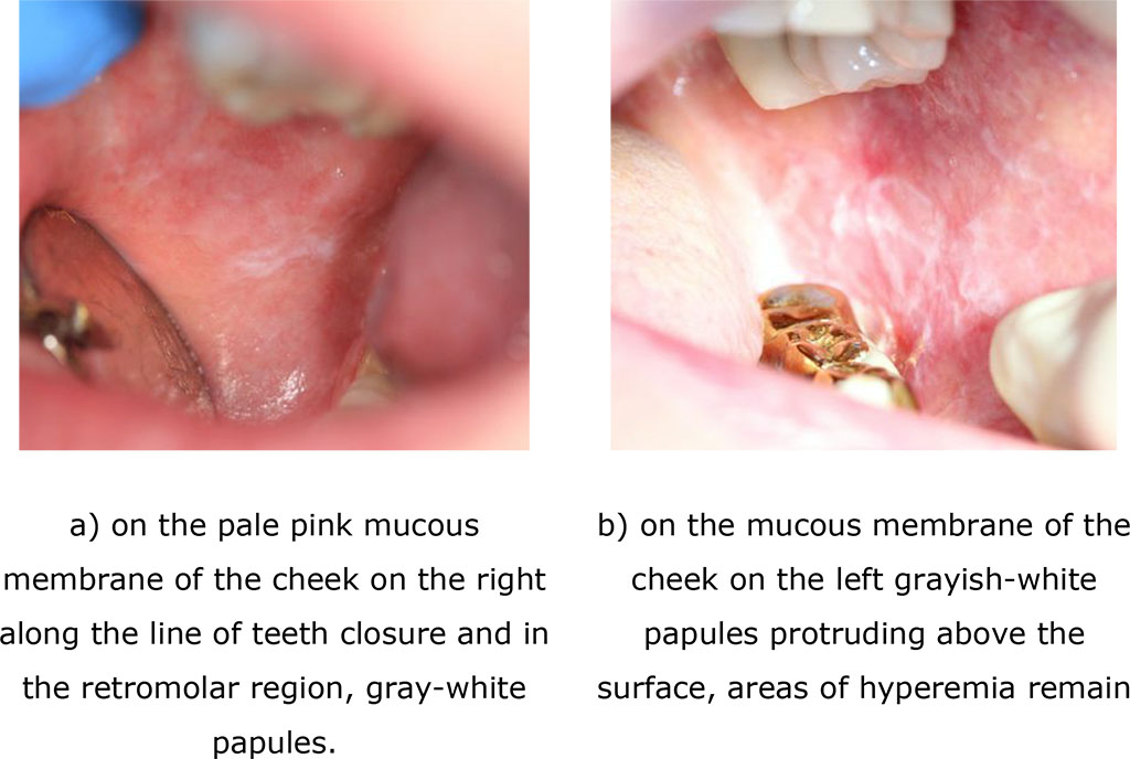 Fig. 6. Clinical manifestations of erosive-ulcerative form of lichen planus after treatment (after 14 days)