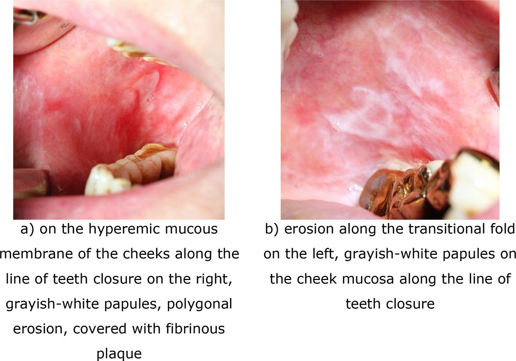 Fig.7. Clinical manifestations of erosive-ulcerative form of lichen planus (exacerbation) after 90 days