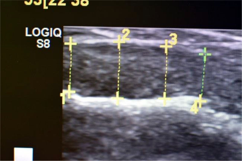 Figure 2. Registration of the obtained indicators of the thickness of the soft tissues of the oral cavity on the monitor screen during the ultrasound examination (RF Patent No. 2722055 dated May 26, 2020).