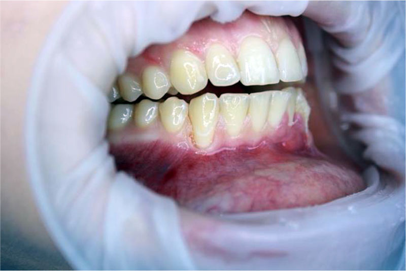 Figure 3. Local recession of class I according to Miller in the region of the 43 tooth.