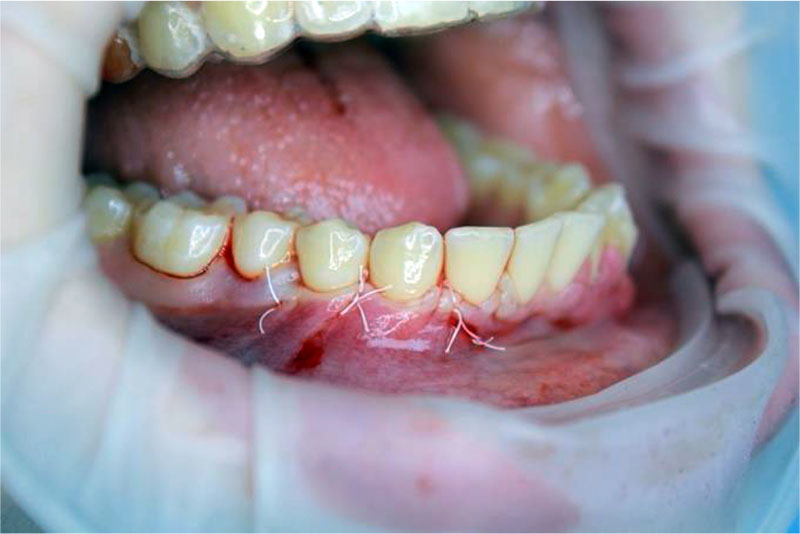 Figure 7. Suturing an operating wound using double twisted sutures PTFE 5.0 (Golnit, Russia).