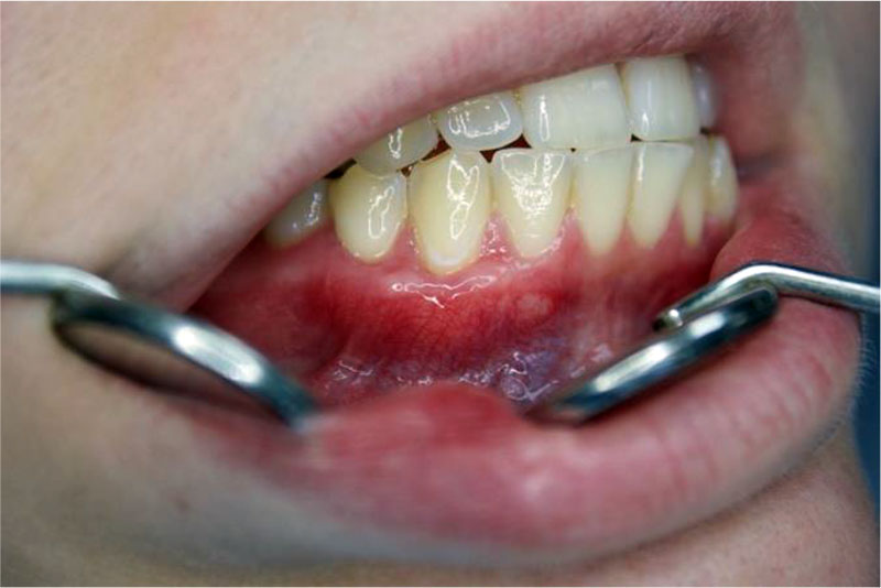 Figure 8. Result in 1 month. Complete defect coverage in the area of 43 teeth. There is an additional volume of keratinized gingiva in the area of 43 teeth.