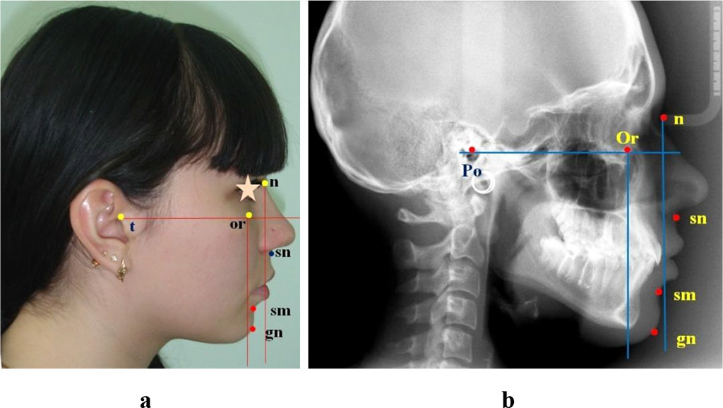 Figure 1 – comparative analysis of the main anatomical structures location in relation to the lines, photo (a), teleroentgenogram (b)