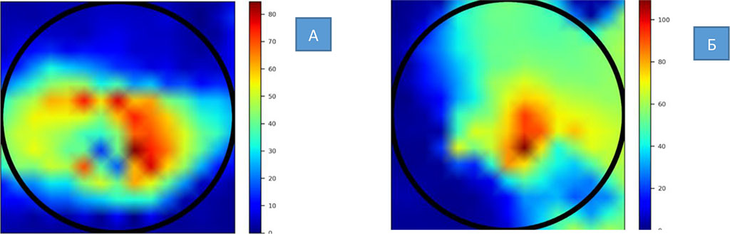 Figure 1. A picture of breast impedance in patients with stage 2 NEO